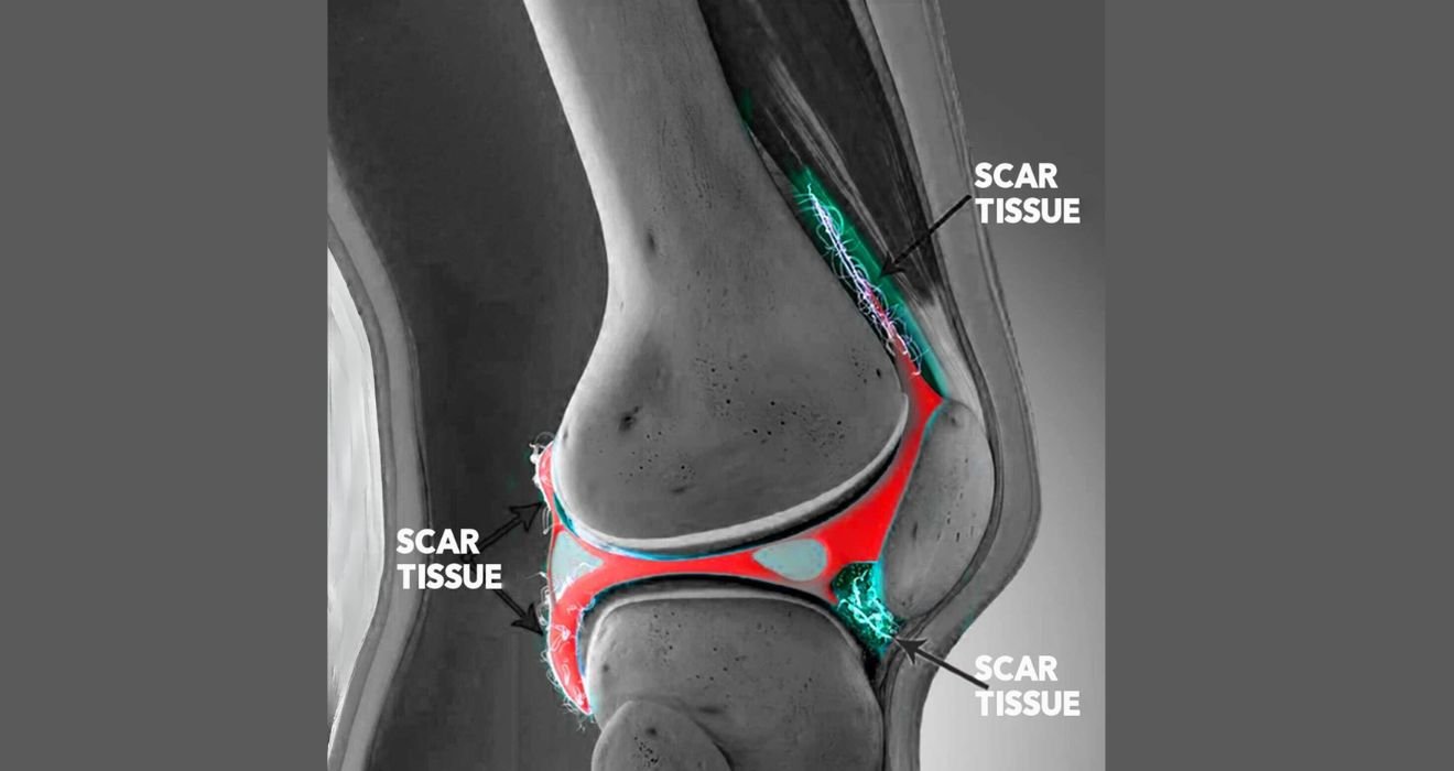 The Science of Scar Tissue