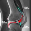 The Science of Scar Tissue Understanding Arthrofibrosis in Knee Replacement Surgery