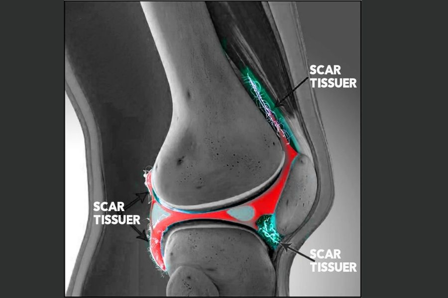 The Science of Scar Tissue Understanding Arthrofibrosis in Knee Replacement Surgery